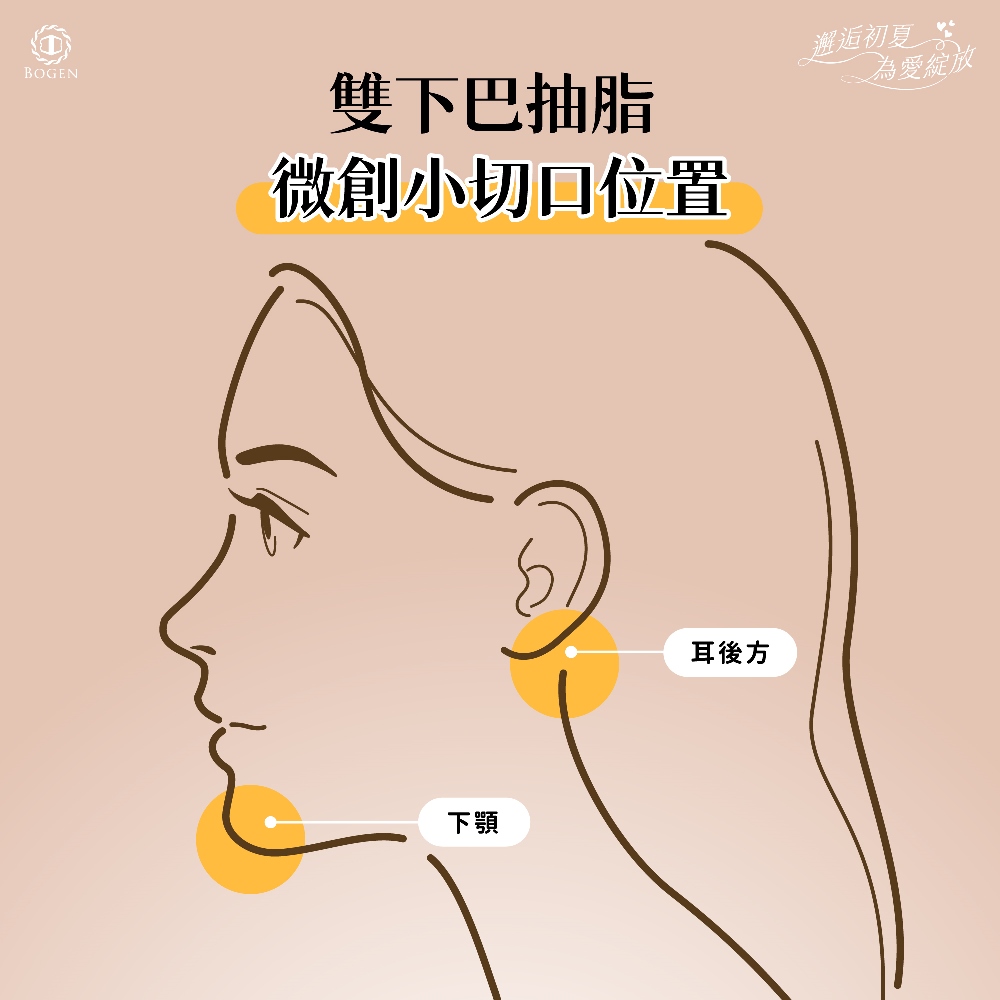雙下巴抽脂切口位置,雙下巴抽脂,博恩妍